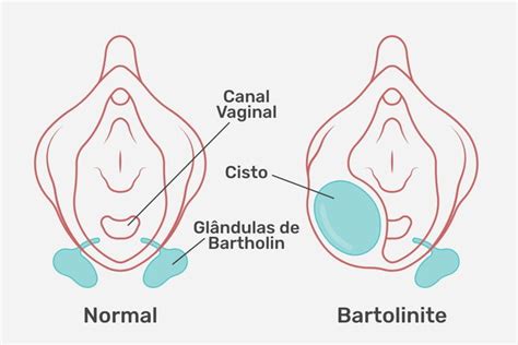 glândulas de bartholin e de skene|Glândulas de Skene: o que são e como tratar quando inflamam